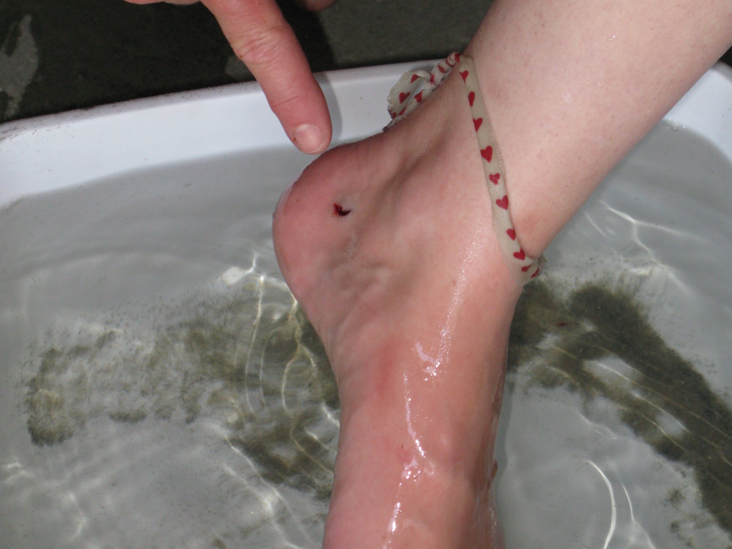 Typische Wunde nach einem Stachelrochen-Stich. Der Fuß wird in ein heißes Wasserbad getaucht.